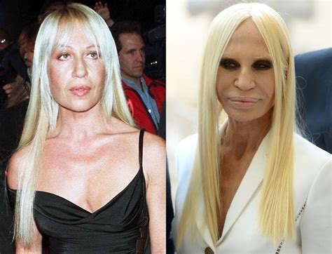 Donatella Versace before surgery